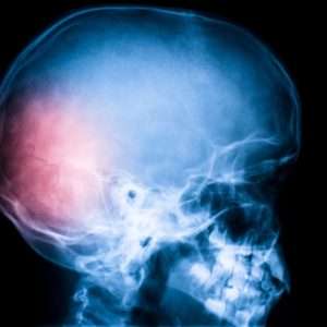 Abordaje Del Profesional De Enfermería En Traumatismo Craneoencefálico Severo (Tce)